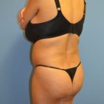 Brazilian Butt Lift Before & After Patient #1200