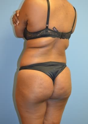 Brazilian Butt Lift Before & After Patient #1197