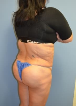 Brazilian Butt Lift Before & After Patient #1195