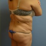Brazilian Butt Lift Before & After Patient #1195