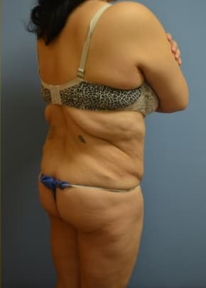 Brazilian Butt Lift Before & After Patient #1195