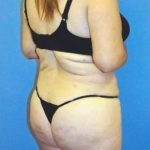 Brazilian Butt Lift Before & After Patient #1192