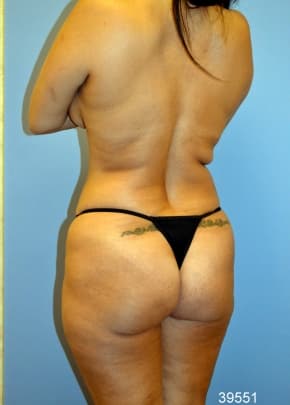 Brazilian Butt Lift Before & After Patient #1191