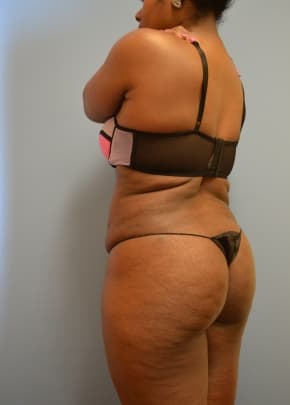 Brazilian Butt Lift Before & After Patient #1190