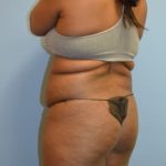 Brazilian Butt Lift Before & After Patient #1190