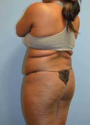 Brazilian Butt Lift Before & After Patient #1190