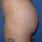 Brazilian Butt Lift Before & After Patient #1189