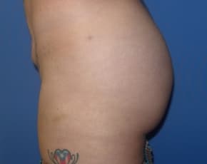 Brazilian Butt Lift Before & After Patient #1189