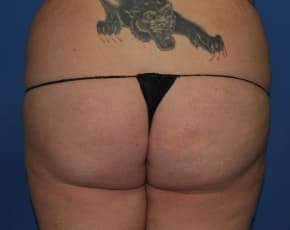Brazilian Butt Lift Before & After Patient #1189