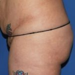 Brazilian Butt Lift Before & After Patient #1189