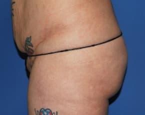 Brazilian Butt Lift Before & After Patient #1189