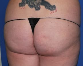 Brazilian Butt Lift Before & After Patient #1189