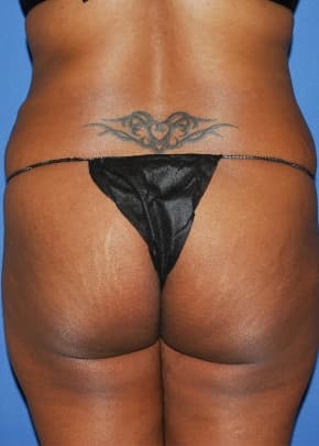 Brazilian Butt Lift Before & After Patient #1188
