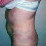 Brazilian Butt Lift Before & After Patient #1187
