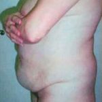 Brazilian Butt Lift Before & After Patient #1187