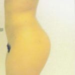 Brazilian Butt Lift Before & After Patient #1186