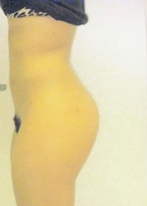 Brazilian Butt Lift Before & After Patient #1186