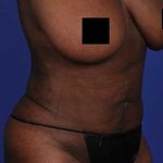 Brazilian Butt Lift Before & After Patient #1185