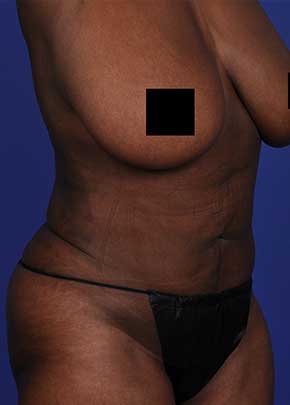 Brazilian Butt Lift Before & After Patient #1185