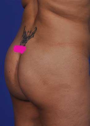 Brazilian Butt Lift Before & After Patient #1183