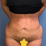 Brazilian Butt Lift Before & After Patient #1158