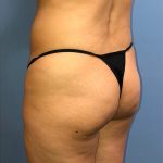 Brazilian Butt Lift Before & After Patient #1158