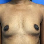 Breast Augmentation Before & After Patient #714