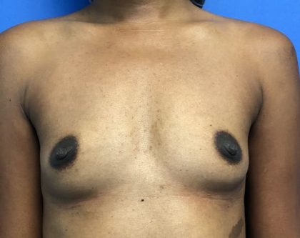 Breast Augmentation Before & After Patient #714