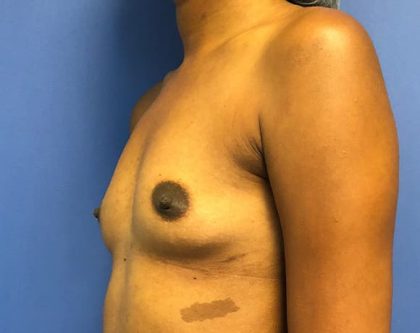 Breast Augmentation Before & After Patient #714