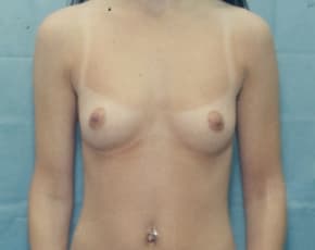 Breast Augmentation Before & After Patient #710