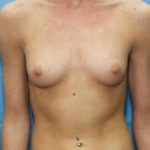 Breast Augmentation Before & After Patient #705