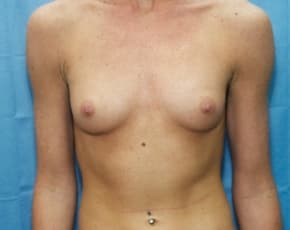 Breast Augmentation Before & After Patient #705