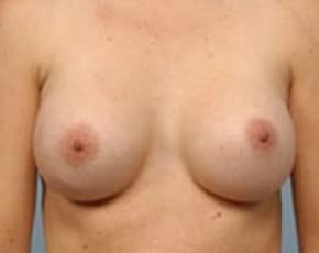 Breast Augmentation Before & After Patient #704