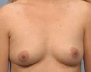 Breast Augmentation Before & After Patient #704