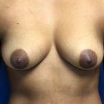 Breast Augmentation Before & After Patient #702