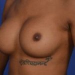 Breast Augmentation Before & After Patient #700