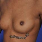 Breast Augmentation Before & After Patient #700