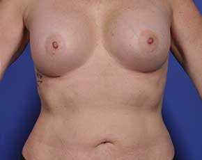 Breast Augmentation Before & After Patient #699