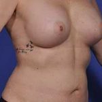 Breast Augmentation Before & After Patient #699