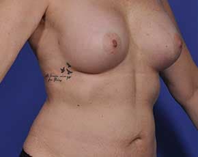 Breast Augmentation Before & After Patient #699