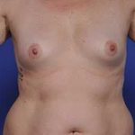 Breast Augmentation Before & After Patient #699