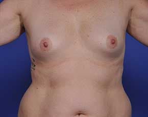 Breast Augmentation Before & After Patient #699