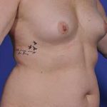 Breast Augmentation Before & After Patient #699