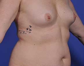 Breast Augmentation Before & After Patient #699