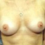 Breast Augmentation Before & After Patient #698