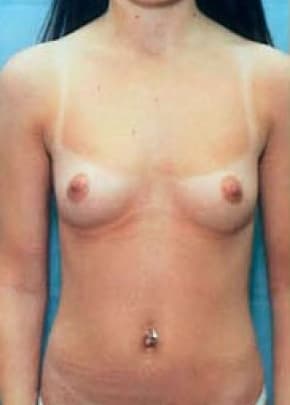 Breast Augmentation Before & After Patient #697