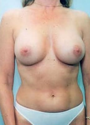 Breast Augmentation Before & After Patient #695