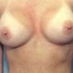 Breast Augmentation Before & After Patient #693