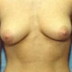 Breast Augmentation Before & After Patient #693