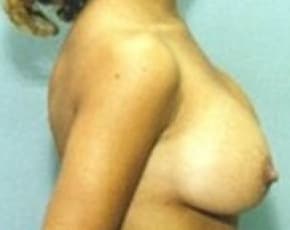 Breast Augmentation Before & After Patient #690